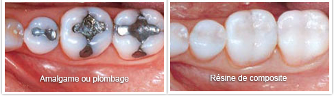 amalgame ou composite dentaire