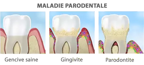 Evolution de la maladie parodontale