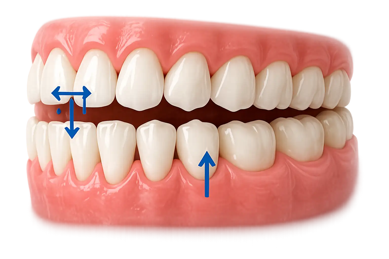 Occlusion dentaire