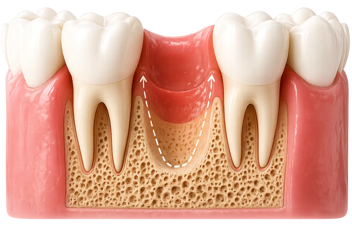 Dent manquante