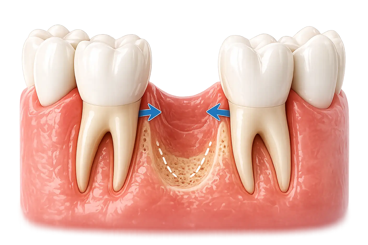Déplacement des dents