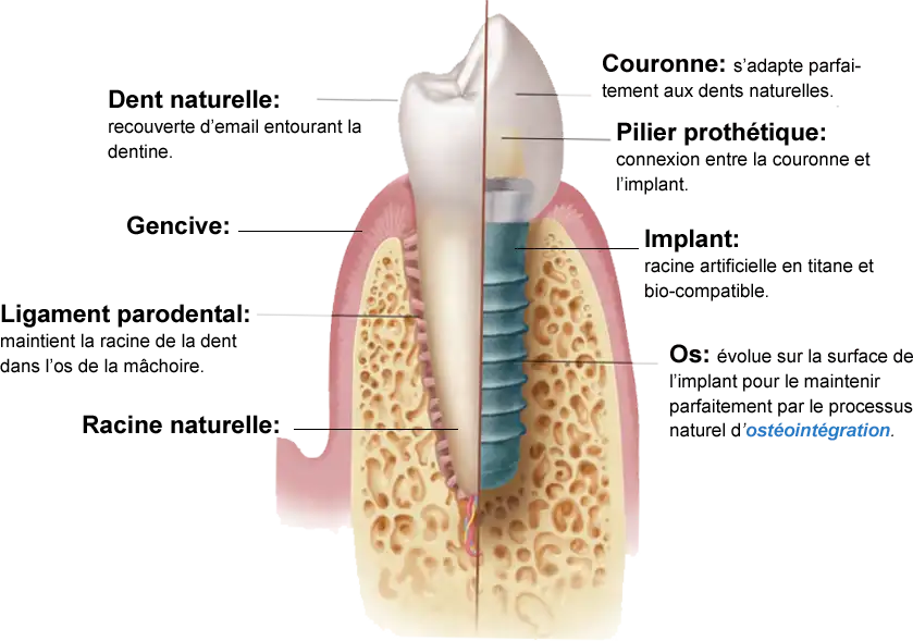 Coupe d'un implants dentaires