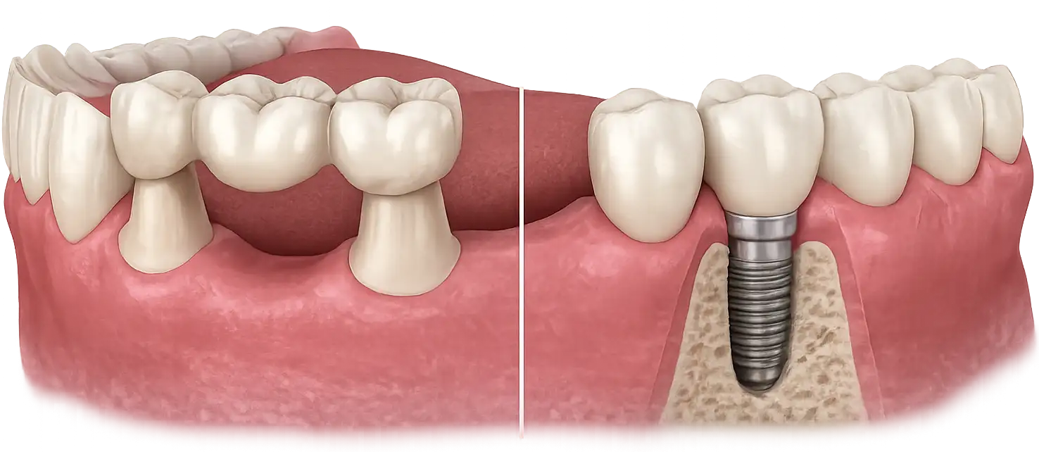 Remplacement d'un bridge par implant dentaire