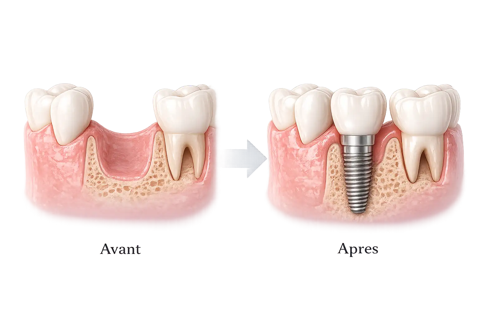 Remplacement d'une dent asente