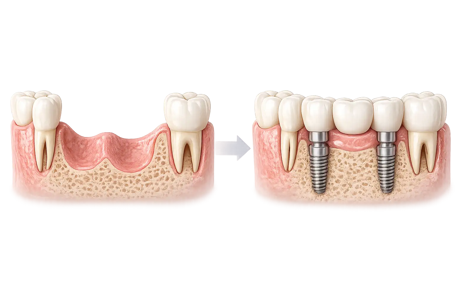 Remplacement de plusieurs dents manquentes