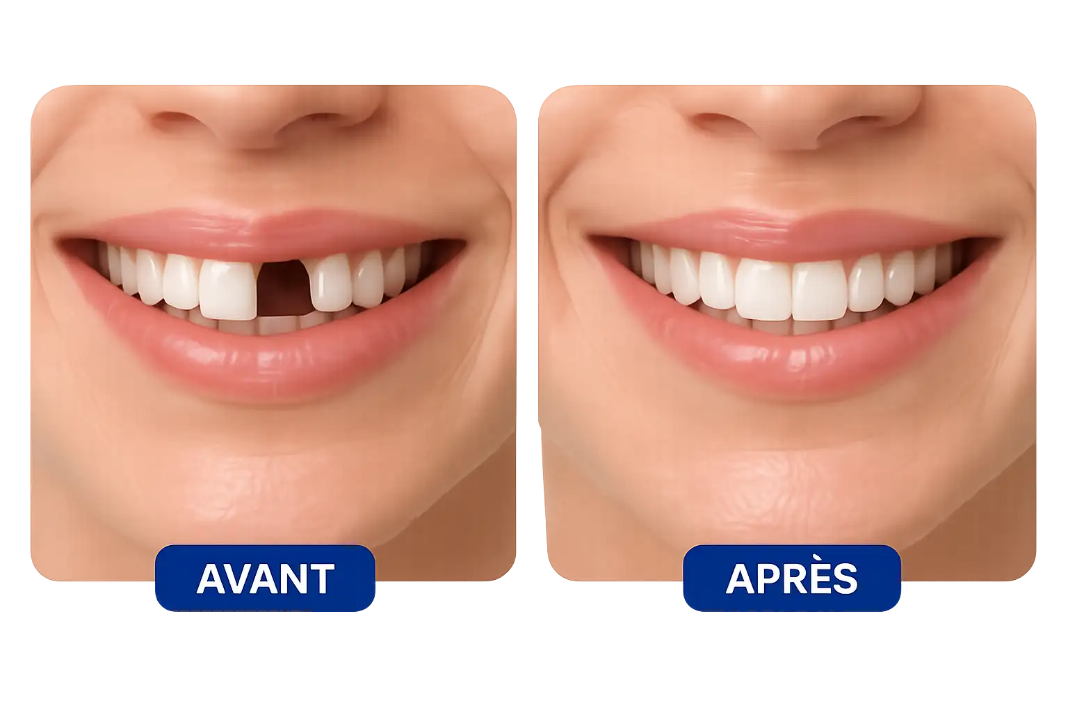 Modification de l'harmonie du sourire