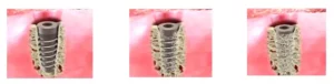 L'ostéointegration avec implants dentaires